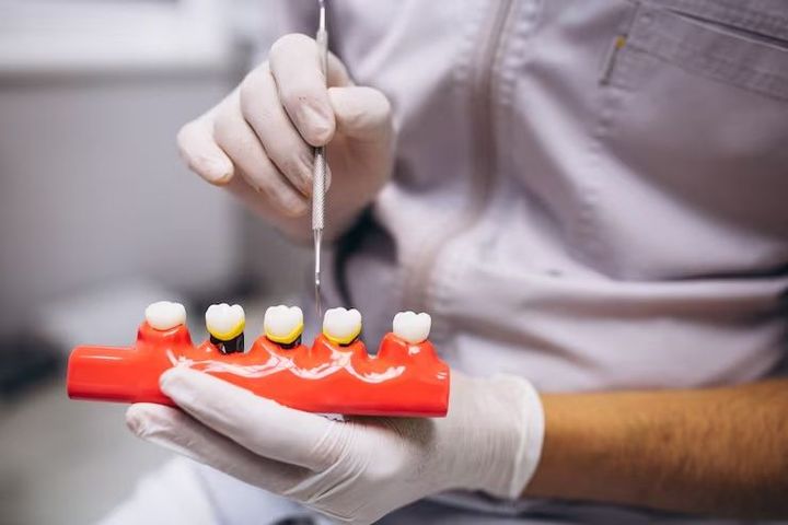 A Guide to Understanding Dental Implants Options: Explanation and Details